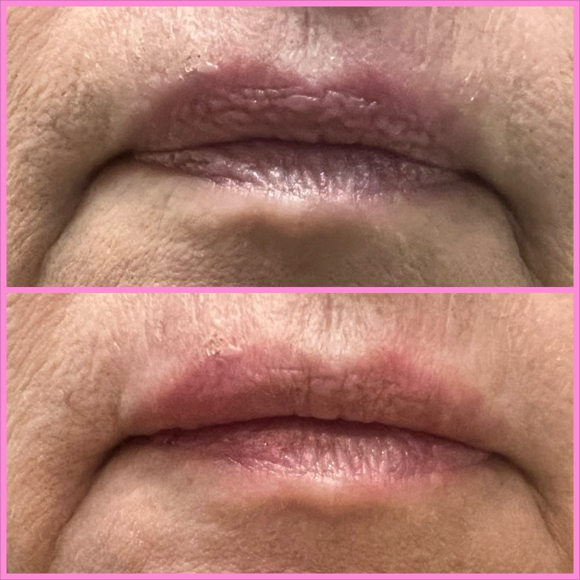 Lip Filler Before and After - Natural Volume Enhancement